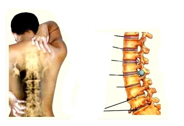 Az osteochondrosis fejlődésének szakaszai