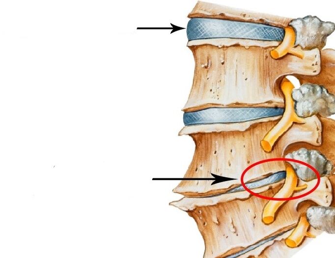 sérült korong és megsértett ideg a méhnyak osteochondrosissal