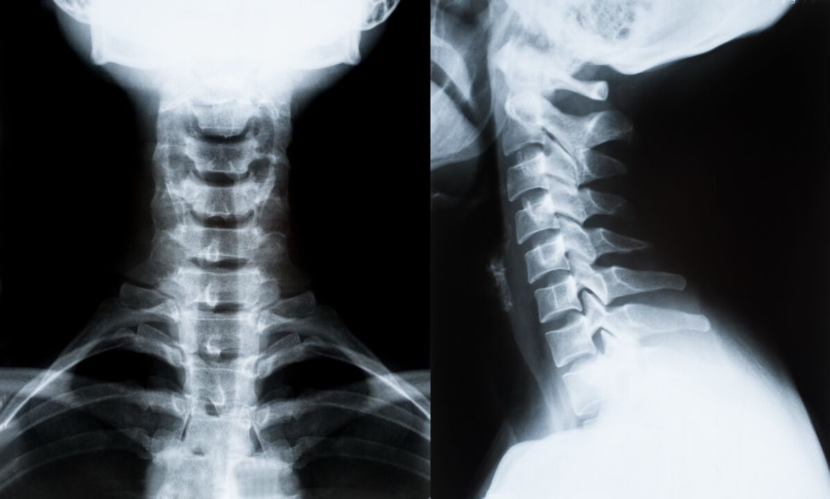 nyaki osteochondrosis röntgenfelvételen